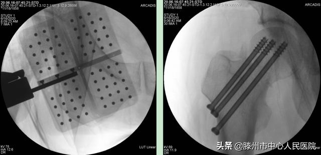滕州市中心人民醫(yī)院成功完成骨科機器人手術