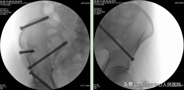 滕州市中心人民醫(yī)院成功完成骨科機器人手術