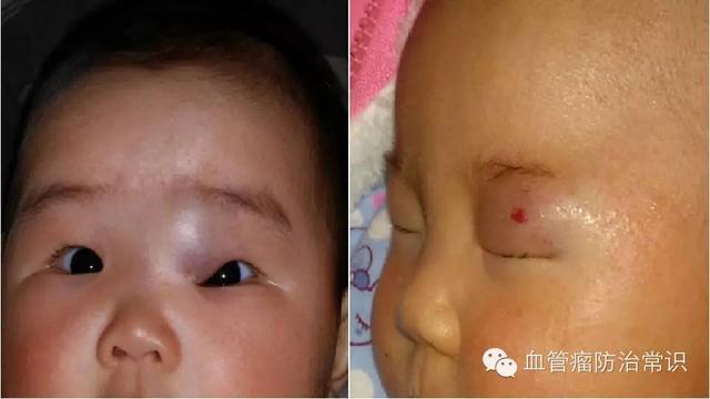 修殘補(bǔ)缺道 醫(yī)美整形路——幫寶寶遠(yuǎn)離紅斑-血管瘤