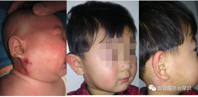 修殘補(bǔ)缺道 醫(yī)美整形路——幫寶寶遠(yuǎn)離紅斑-血管瘤