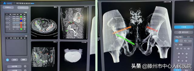 滕州市中心人民醫(yī)院成功完成骨科機器人手術