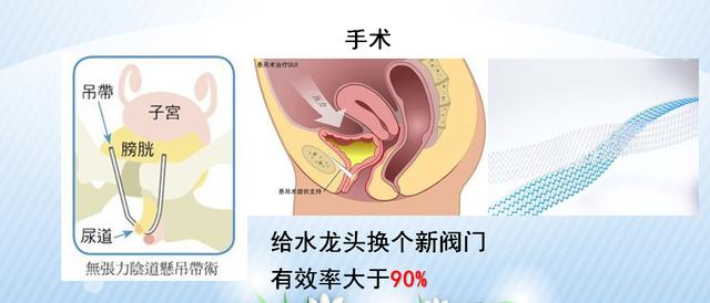 咳嗽、大笑……滴滴答答的尷尬，關(guān)于尿失禁的那些事