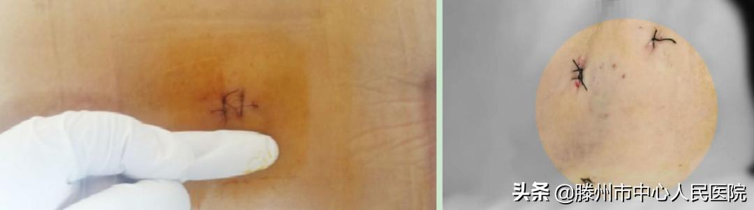 滕州市中心人民醫(yī)院成功完成骨科機器人手術