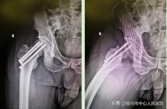 滕州市中心人民醫(yī)院成功完成骨科機器人手術