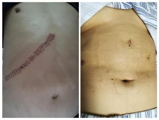 肝膽血管外科獨立開展腹腔鏡下肝血管瘤切除術(shù)