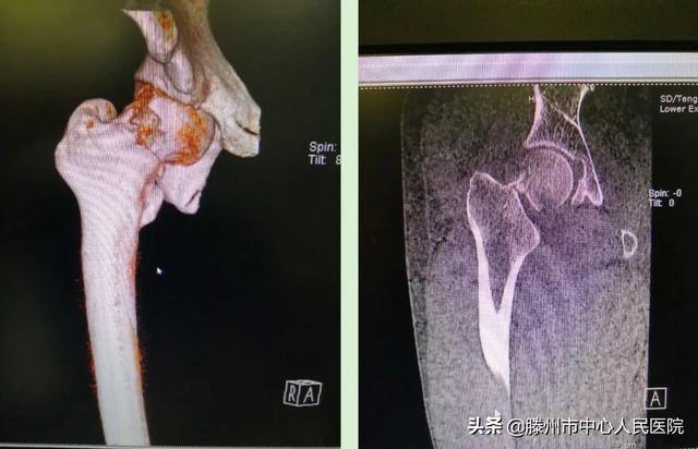 滕州市中心人民醫(yī)院成功完成骨科機器人手術