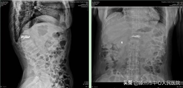 滕州市中心人民醫(yī)院成功完成骨科機器人手術