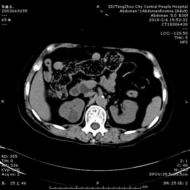 急診ERCP，讓生命垂?；颊咿D(zhuǎn)危為安