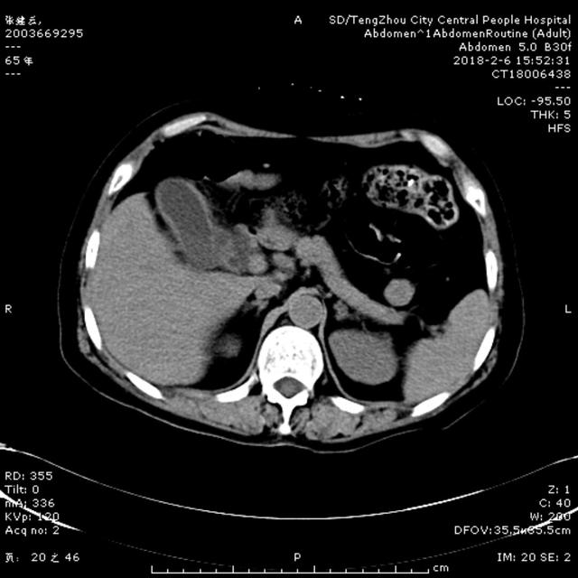 急診ERCP，讓生命垂?；颊咿D(zhuǎn)危為安