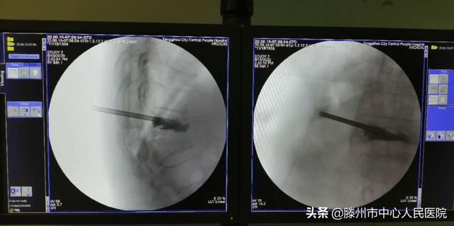 滕州市中心人民醫(yī)院成功完成骨科機器人手術