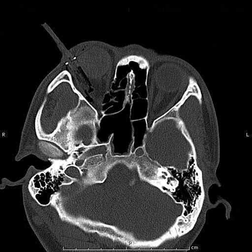 眼二科：鋼筆戳入眼瞼，手術(shù)6小時順利取出，患者眼球保住