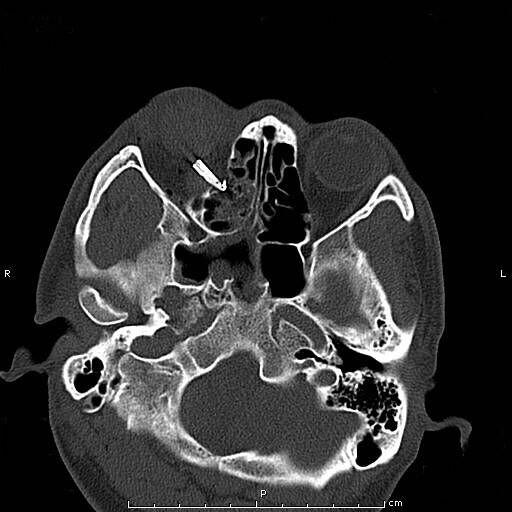 眼二科：鋼筆戳入眼瞼，手術(shù)6小時順利取出，患者眼球保住