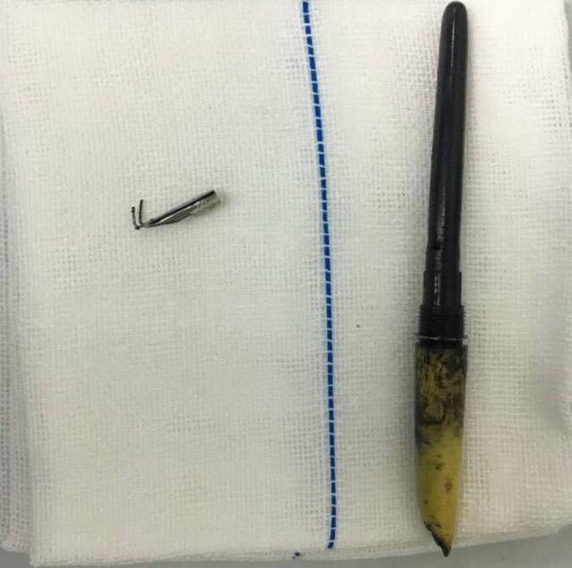 眼二科：鋼筆戳入眼瞼，手術(shù)6小時順利取出，患者眼球保住