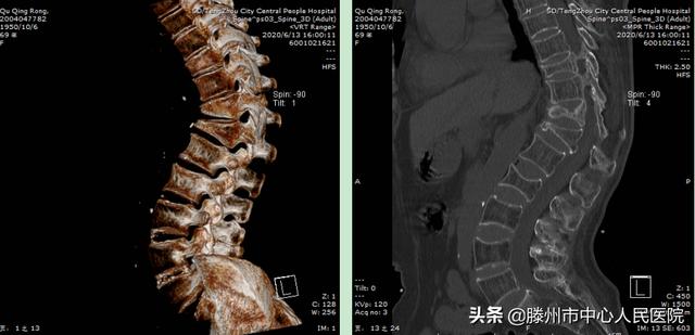 滕州市中心人民醫(yī)院成功完成骨科機器人手術