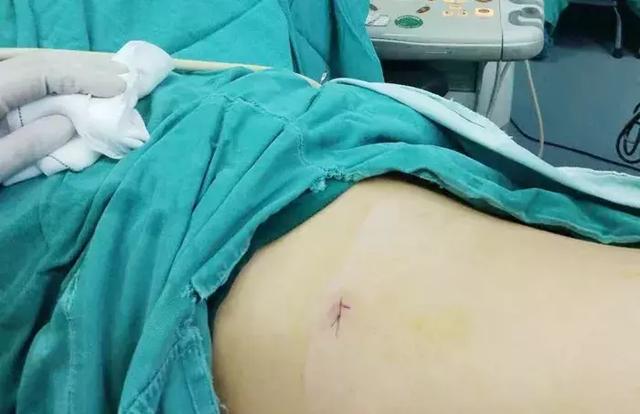 泌尿外科成功實施我院首例無管化經(jīng)皮腎鏡碎石取石術(shù)