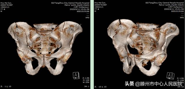 滕州市中心人民醫(yī)院成功完成骨科機器人手術