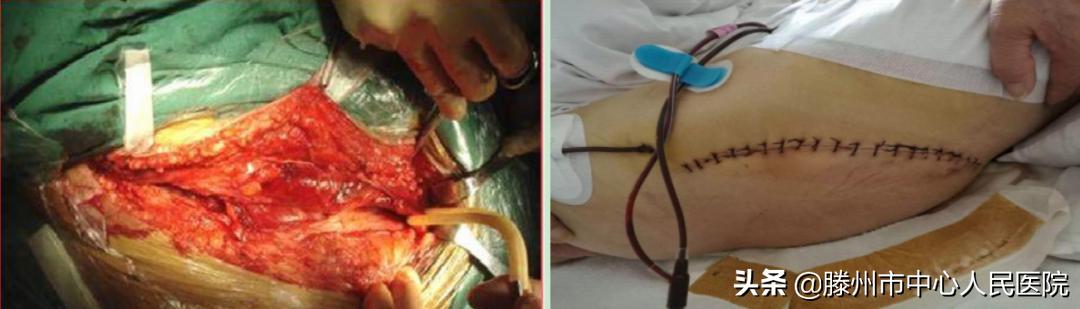 滕州市中心人民醫(yī)院成功完成骨科機器人手術